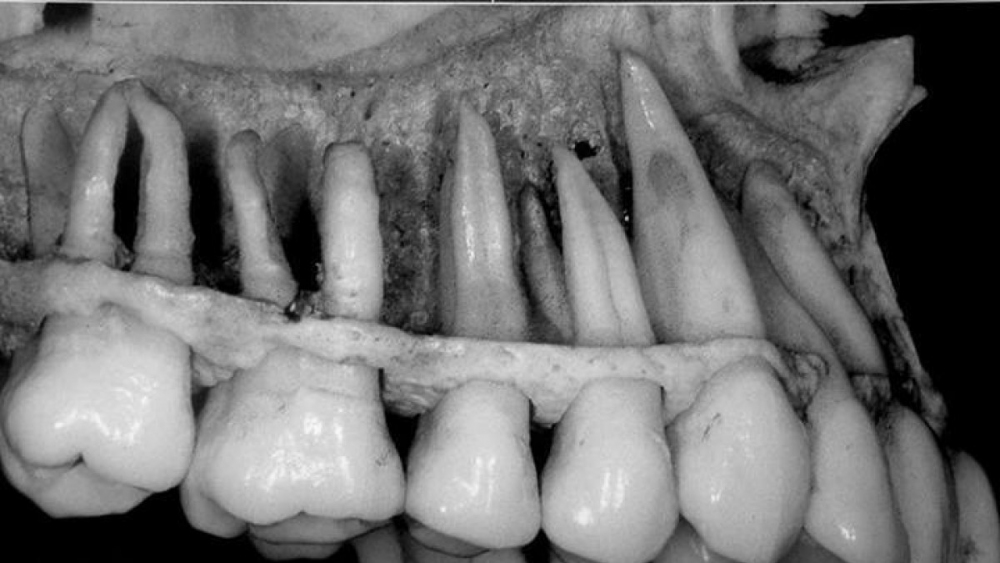 Dişlerinizin 3'te 2'sinın diş etinizin altında olduğunu biliyor muydunuz?