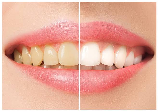 Daha beyaz dişler için 5 doğal yöntem detaylar açıklama da?