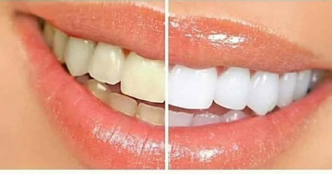 Diş sarılığı nasıl gider?